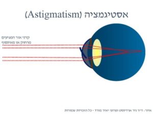 הסבר אסטיגמציה (צילנדר) מאת ד"ר ניר ארדינסט ופרופ' יאיר מורד