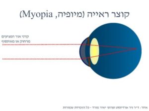 הסבר קוצר ראייה מאת ד"ר ניר ארדינסט ופרופ' יאיר מורד