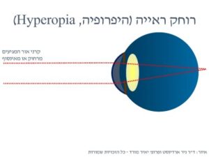 הסבר רוחק ראייה מאת ד"ר ניר ארדינסט ופרופ' יאיר מורד