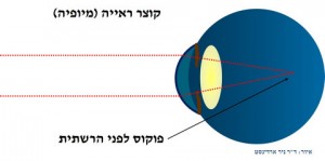 קוצר ראייה הגדרה: קרני האור נשברים חזק מידי בעין עם קוצר ראייה (מיופיה) ולכן קרני האור יהיו לפני רשתית העין, תמונה ד"ר ניר ארדינסט