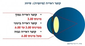 קוצר ראייה סיווג לפי עוצמה, תמונה ד"ר ניר ארדינסט