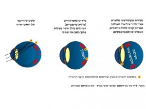 סיבות לקוצר ראייה ד"ר ניר ארדינסט ופרופ' יאיר מורד