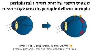 טשטוש היקפי של רוחק ראייה ד"ר ניר ארדינסט ופרופ' יאיר מורד